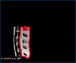Custom boundary detection for L1 vertebrae showing extracted lower boundary contour